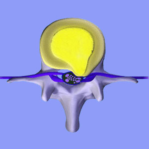 Sciatic Nerve Damage from a Herniated Disc - Sciatica