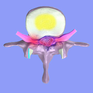 Sciatica from a Herniated Disc - Sciatica