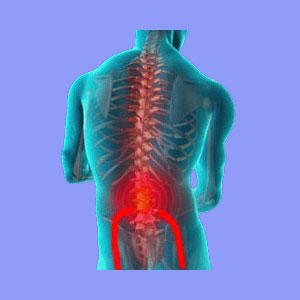 Sciatica Neuralgia - Sciatica