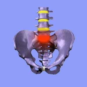 Sciatica S1 - Sciatica